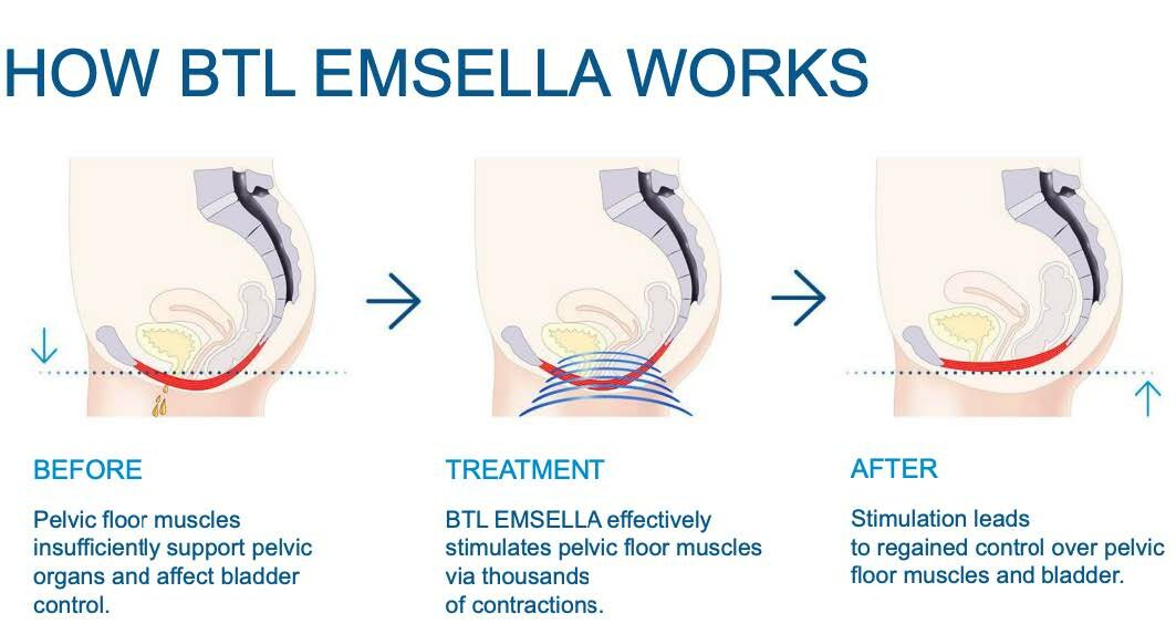 Emsella - Treatment for Incontinence